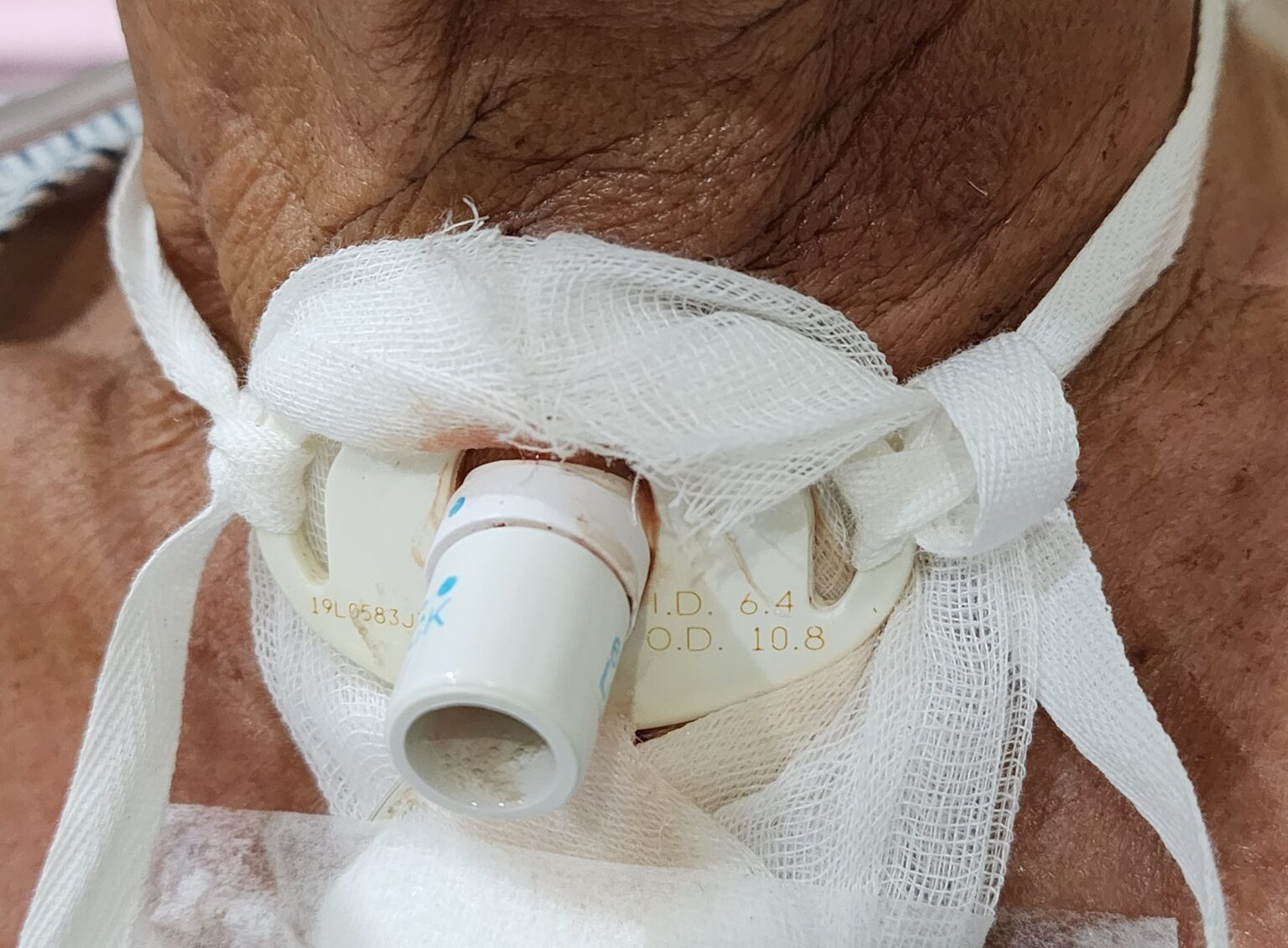 The Tracheostomy Procedure Why is it needed Dr. Ruth Otolaryngology