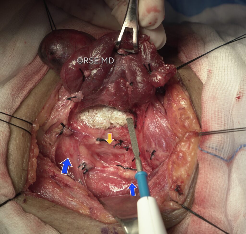 laryngeal nerve and parathyroid in thyroid surgery- ent surgeon palawan