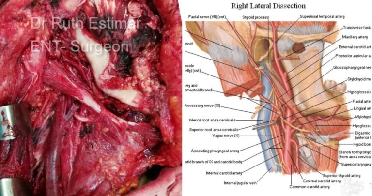 parotidectomy cancer surgeon ent doctor palawan