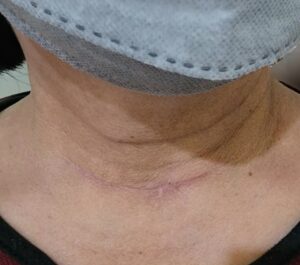 thyroidectomy scar 2 months post-op- ent surgeon palawan