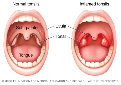 tonsils normal top ENT doctor surgeon puerto princesa