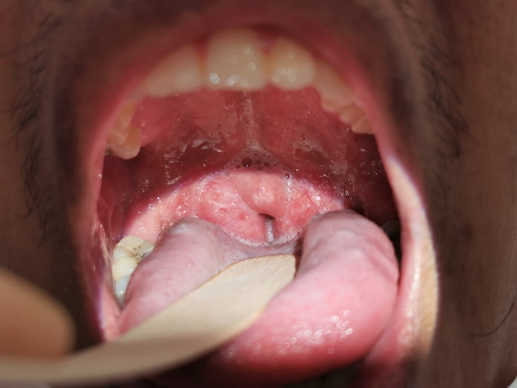 kissing tonsils enlarged tonsils ent surgeon palawan