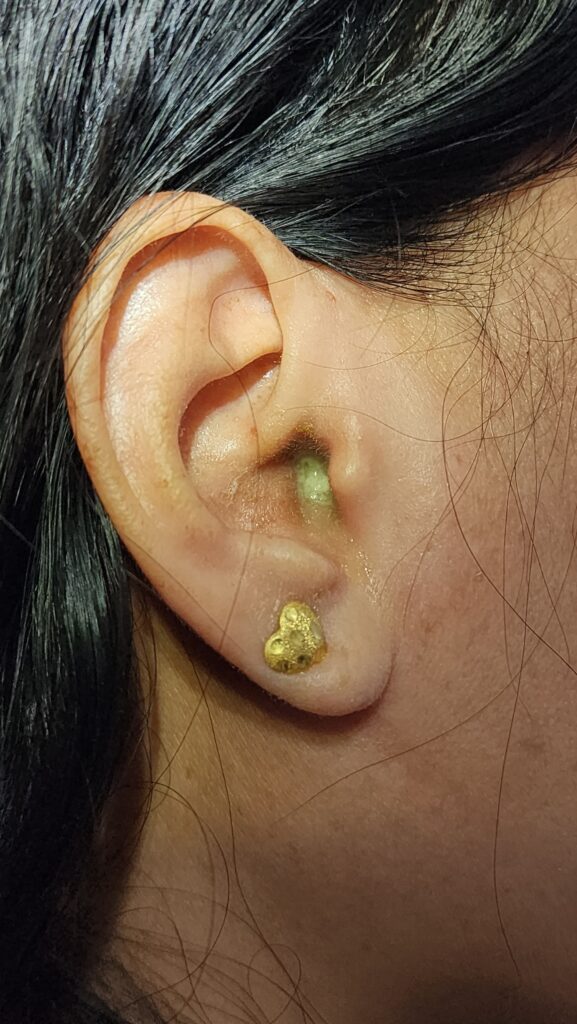 ear canal infection otitis externa- ent doctor palawan