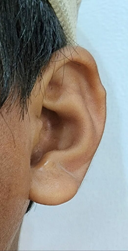 ear picture - ent doctor palawan