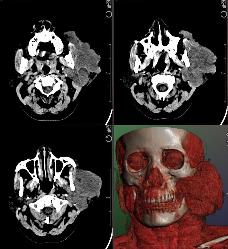 parotid cancer ct scan best ent doctor neck surgeon palawan