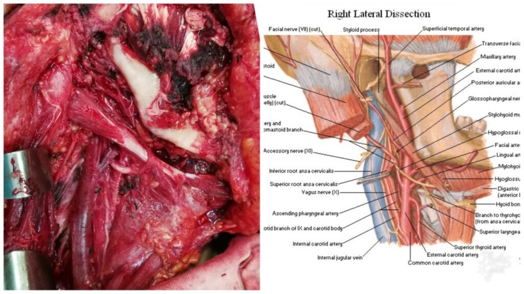 parotid cancer surgery and anatomy best ent doctor neck surgeon palawan