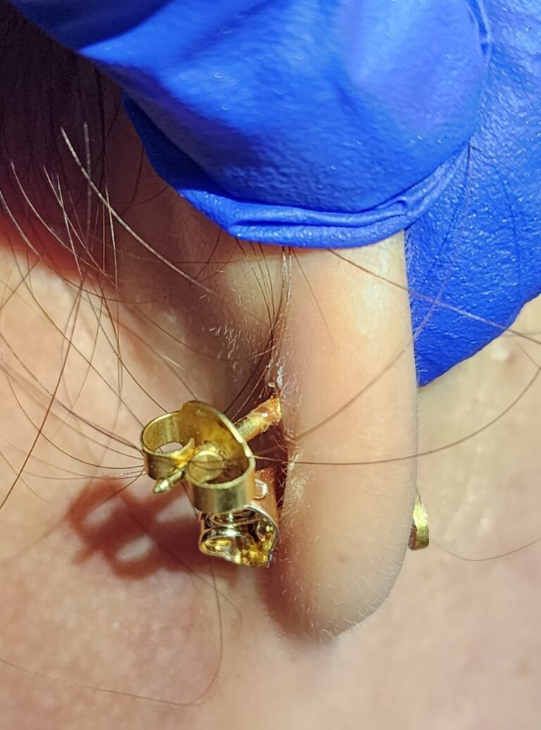 ear piercing extrusion treated