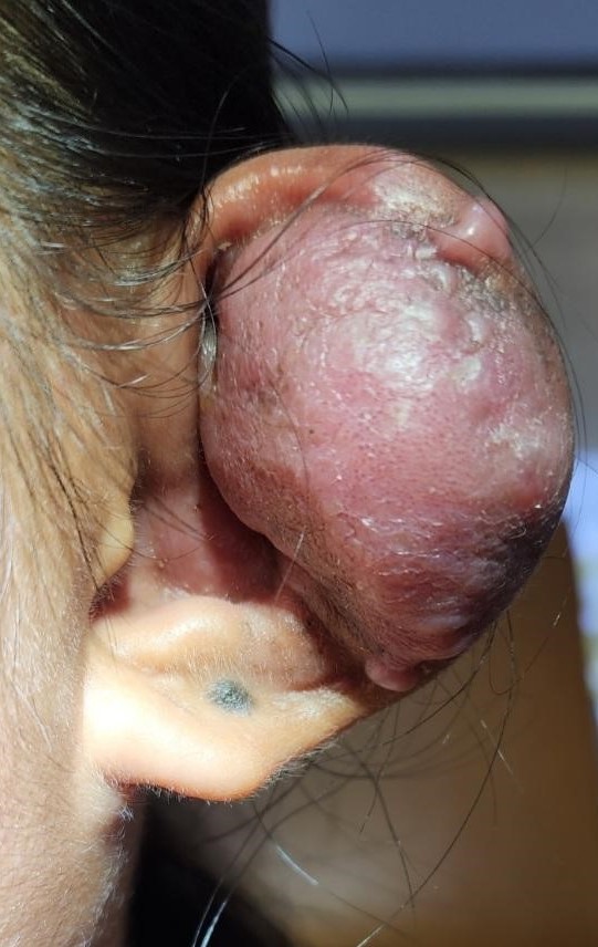 ear piercing infection