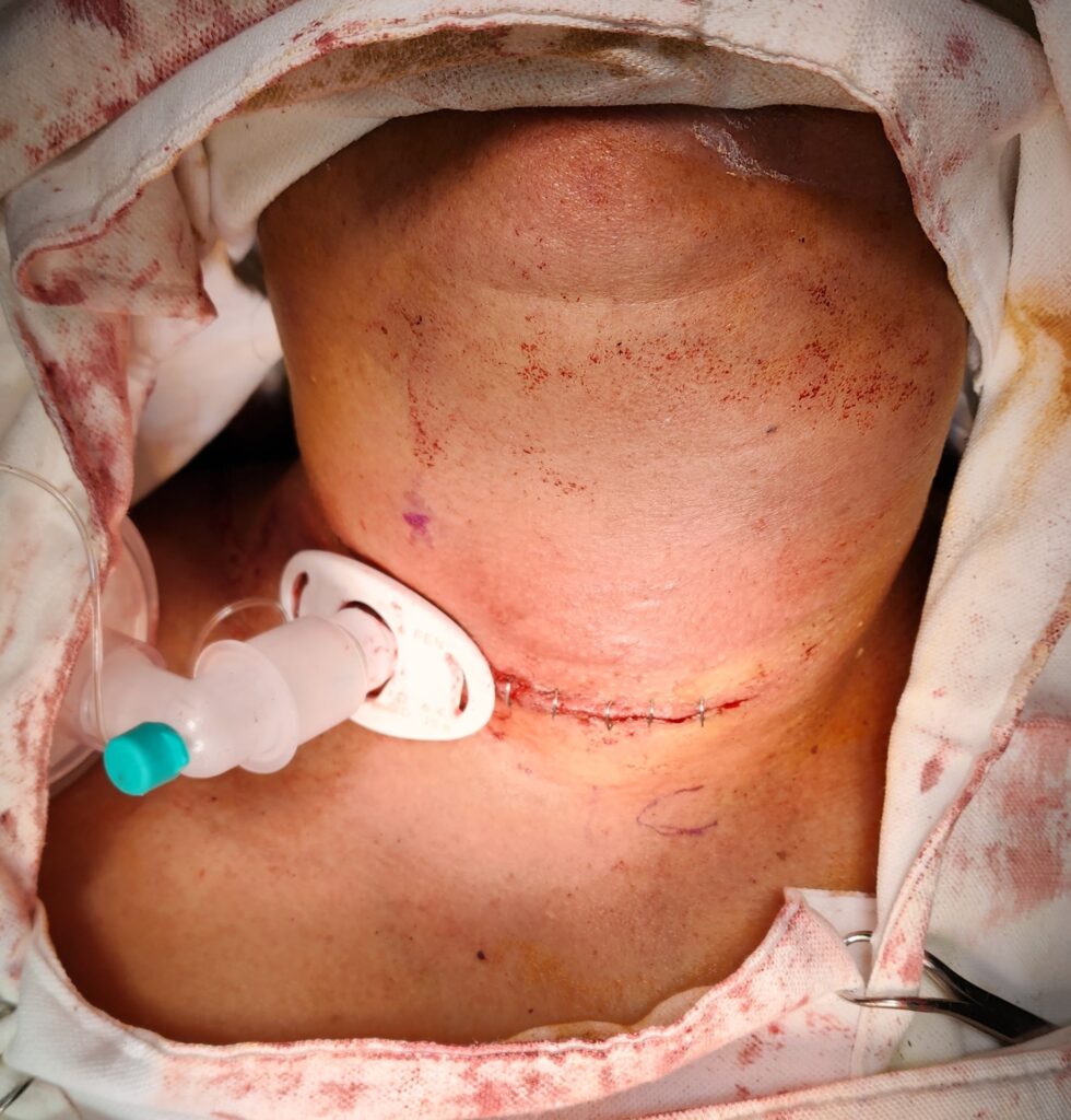 deviated tracheostomy from large anaplastic thyroid cancer- ENT surgeon palawan