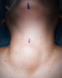 anaplastic cancer thyroidectomy- ENT surgeon Palawan