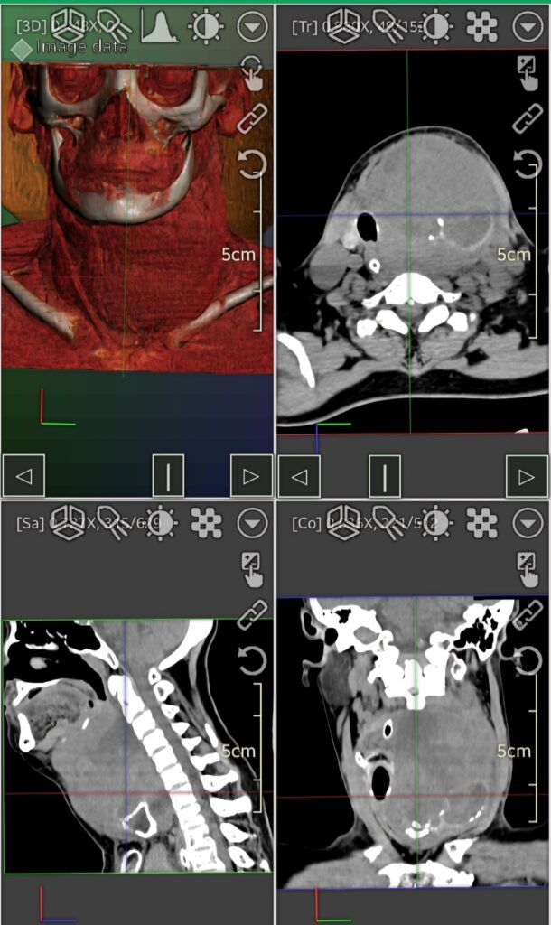 ct scan of large anaplastic thyroid cancer- ENT surgeon Palawan