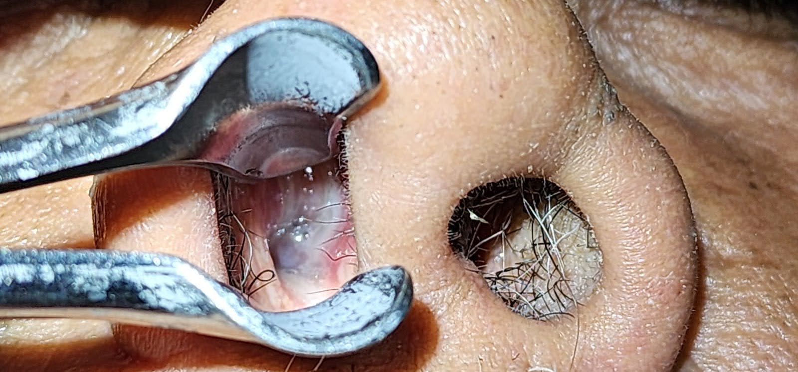 Grape-like Growths in the Nose: Nasal Polyps - Dr. Ruth - Otolaryngology, image size:1600x747