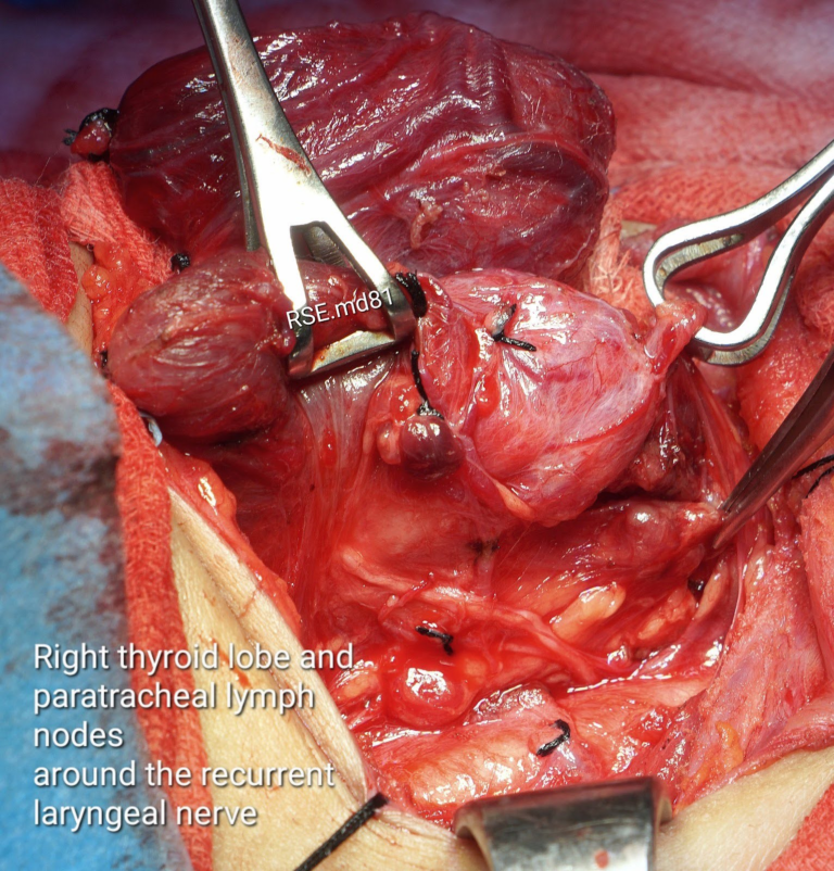 thyroid cancer papillary thyroidectomy with paratracheal lymph nodes ENT palawan