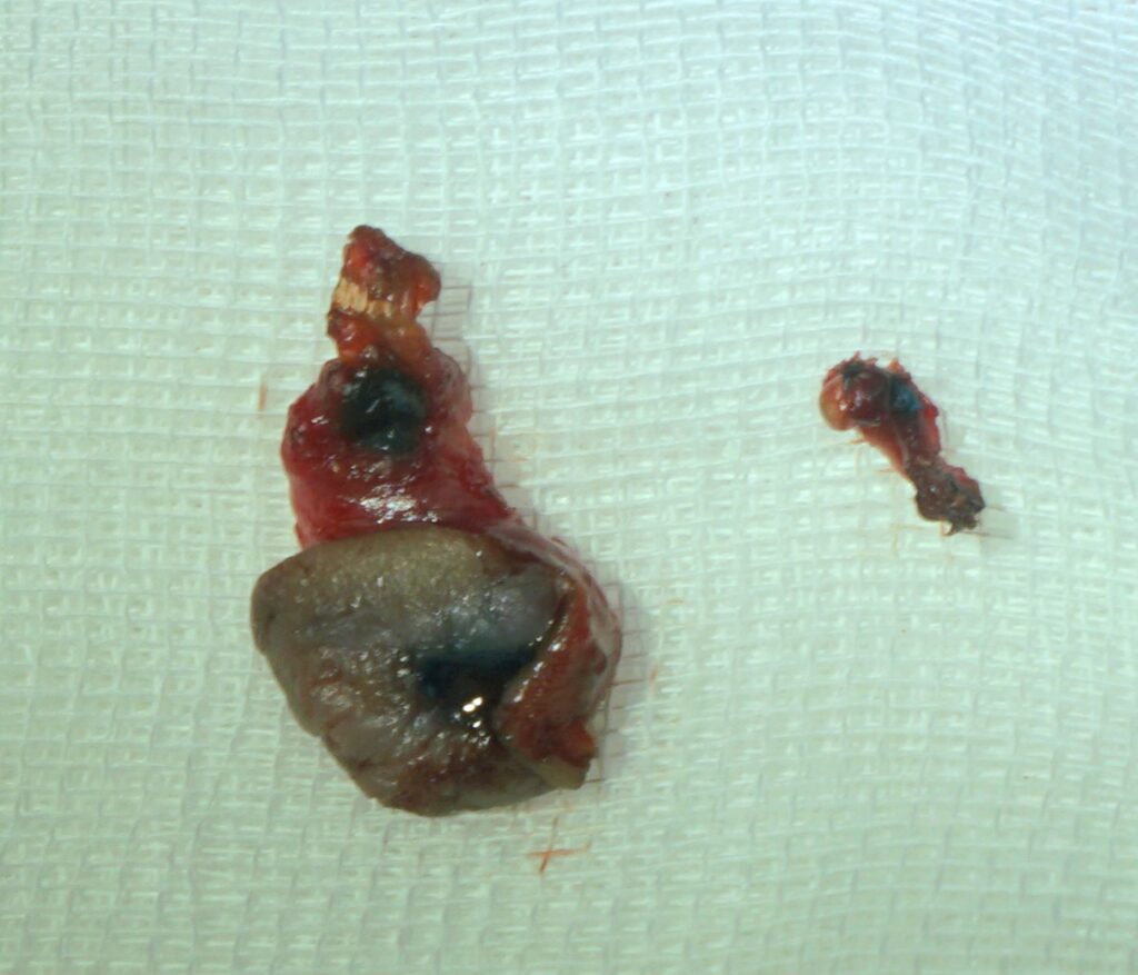 specimens of excised pre auricular sinus done by ENT surgeon in palawan - both left and right