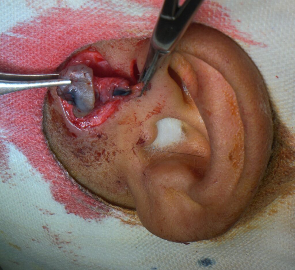 use of dye as guide in pre-auricular sinus surgery -ENT palawan