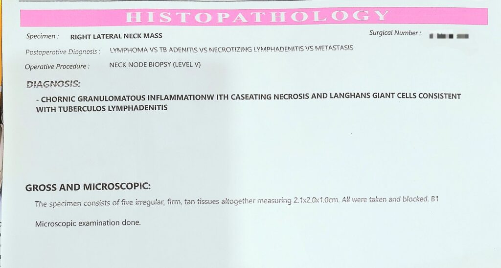 biopsy results of Tuberculosis of neck lymph nodes-