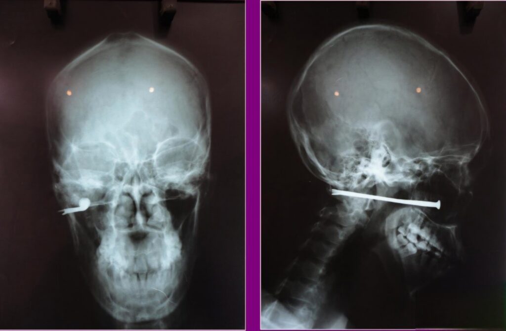 4 inch nail stuck in face - xray