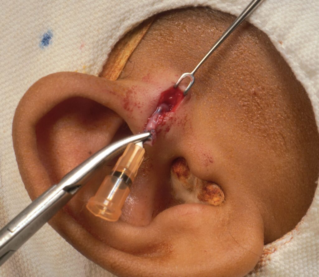 pre-auricular sinus -not infected- ENT surgeon Palawan- surgery pic