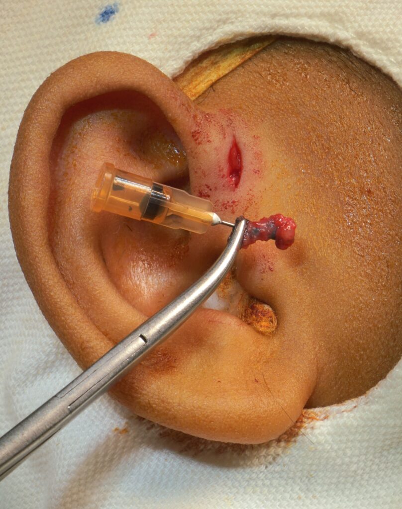 pre-auricular sinus -not infected- ENT surgeon Palawan- surgery pic