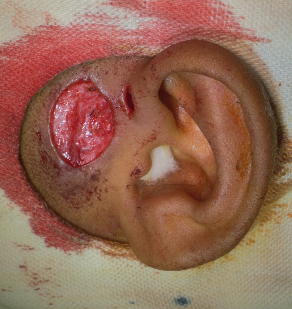 post op- defect in infected pre-auricular sinus surgery - ENT surgeon palawan