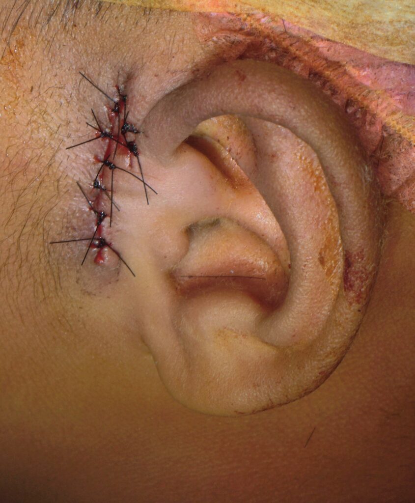 sutured post op- defect in infected pre-auricular sinus surgery - ENT surgeon palawan