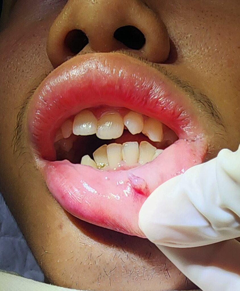 inner lip mucocele- ENT palawan